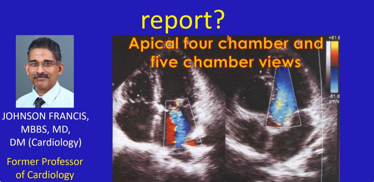 johnsoncardiol's tweet photo. Echocardiogram, often called just echo in short is ultrasound imaging of the heart. Though the actual types of details mentioned in echo report may vary between institutions and even persons reporting it, in general there are several common aspects. https://t.co/R7QIakCsyR https://t.co/EdpCjRrWnk