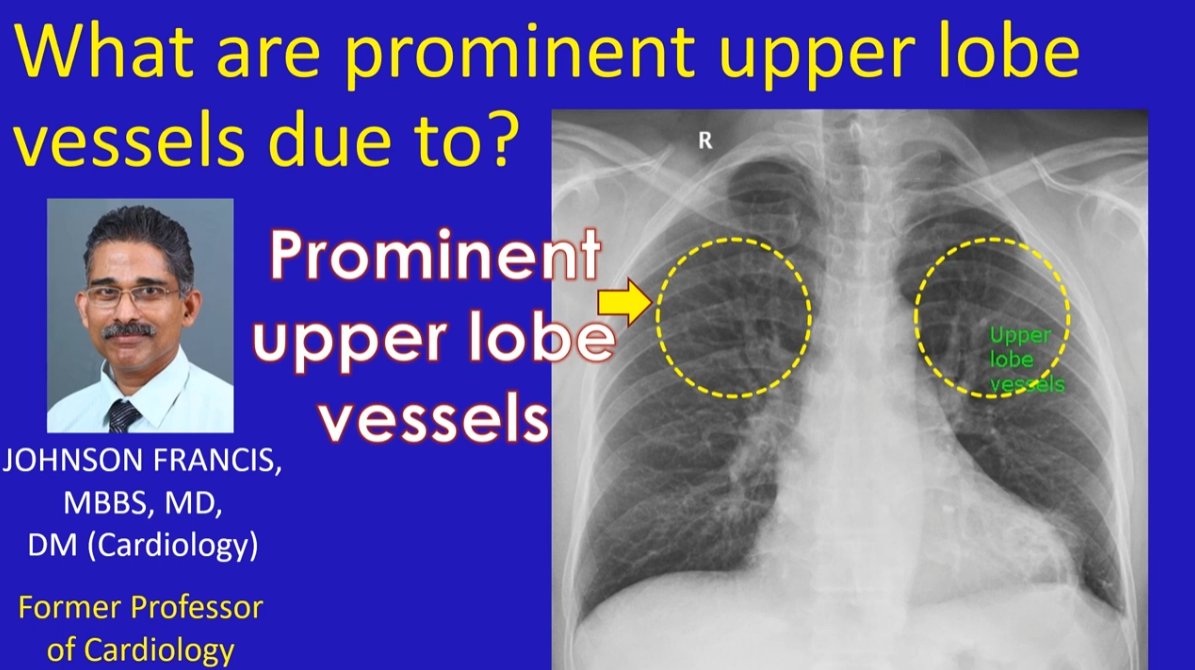 johnsoncardiol's tweet photo. Prominent upper lobe vascular markings on CXR suggest pulmonary venous hypertension. Actually, they are dilated pulmonary veins, though it is not easy to differentiate between veins and arteries on CXR, hence the term prominent upper lobe vessels. https://t.co/nIKYqOR0sc https://t.co/vbYRcJ9ch4