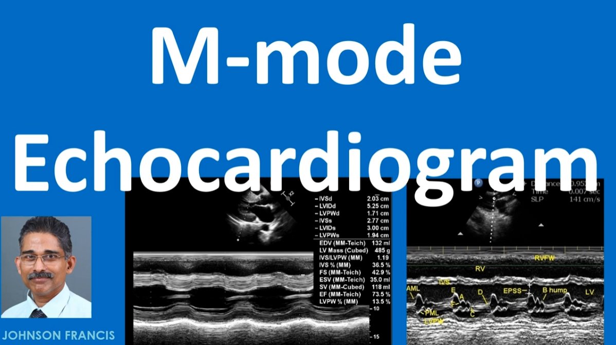 johnsoncardiol's tweet photo. M-Mode echocardiogram is short form for Time-Motion Mode echocardiography. It was one of the earliest modes of echocardiography. There was also a B-Mode or brightness mode along with it.https://t.co/kX3jBBK9za https://t.co/5LWx4vihRW