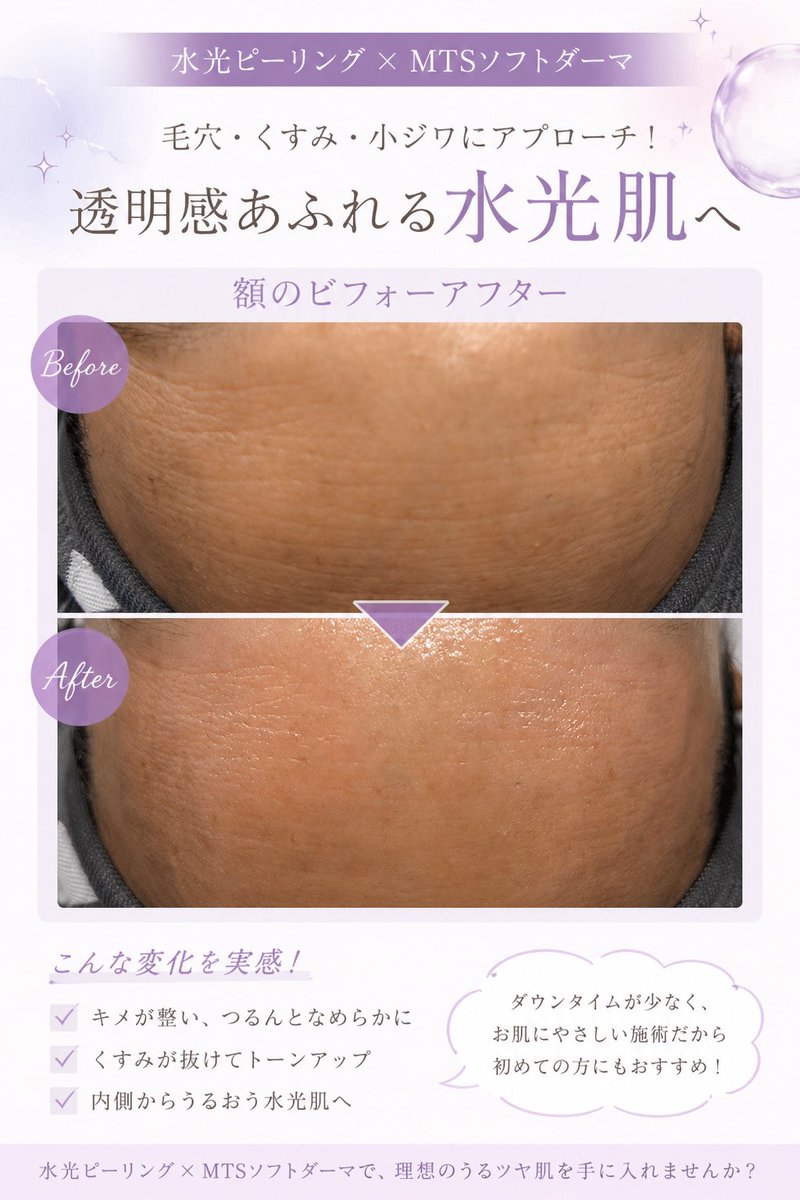 d0_rwo's tweet photo. 夏本番きたー！！
肌の治安大丈夫！？
8月はなんとブログ読んだよ📣で
全メニューから￥1,000オフ🉐キャンペーン✨️
ぜひチェックしてね📍

https://t.co/yCUew7ggpB https://t.co/6aZM8o9Ffg