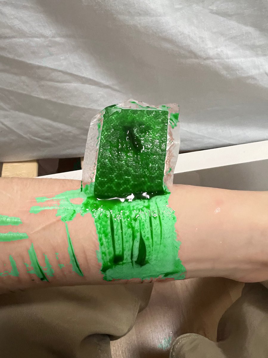 skeletroon's tweet photo. The fake vein I hit https://t.co/wCG7QEedTA
