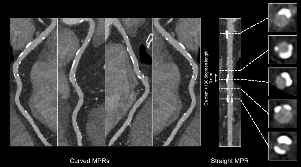 ColletCarlos's tweet photo. It is remarkable how quickly photon-counting CT #PCCT is transforming clinical practice. We now use CT to characterize coronary calcium before #PCI, enabling more precise lesion preparation. I believe PCCT will become the standard for coronary CT within the next five years. https://t.co/0sf9le6TKo