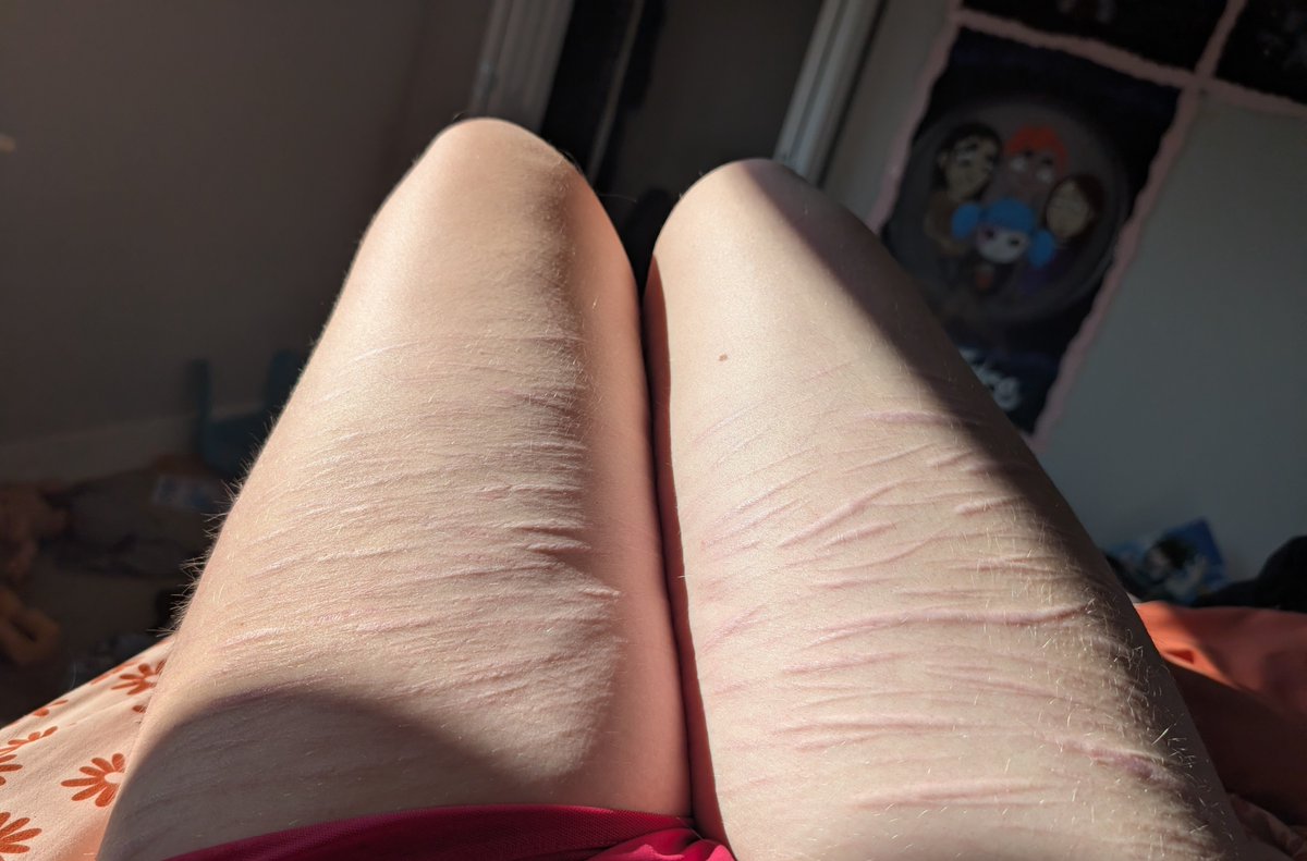 Mr_Max742's tweet photo. #scars #shtwt #shedtwt  sorry you got some bush action https://t.co/pfnwKXtrWF