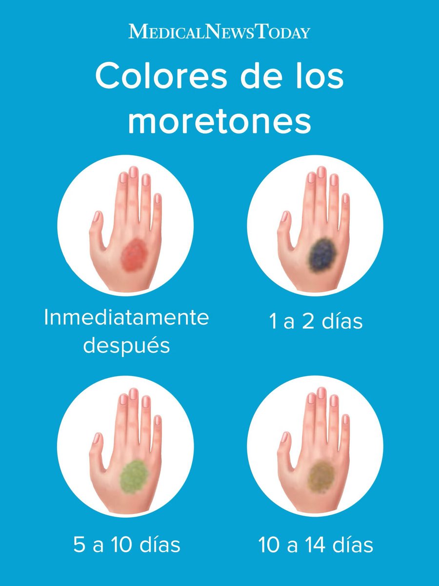 HugoQui17061363's tweet photo. Según ella ese golpe es del sábado 
Si tomamos en cuenta la imagen ese golpe ya debería estar morado 

Échale ganitas para mentir roro 
3 peso de maquillaje o creatividad https://t.co/Hw2iLffZCO