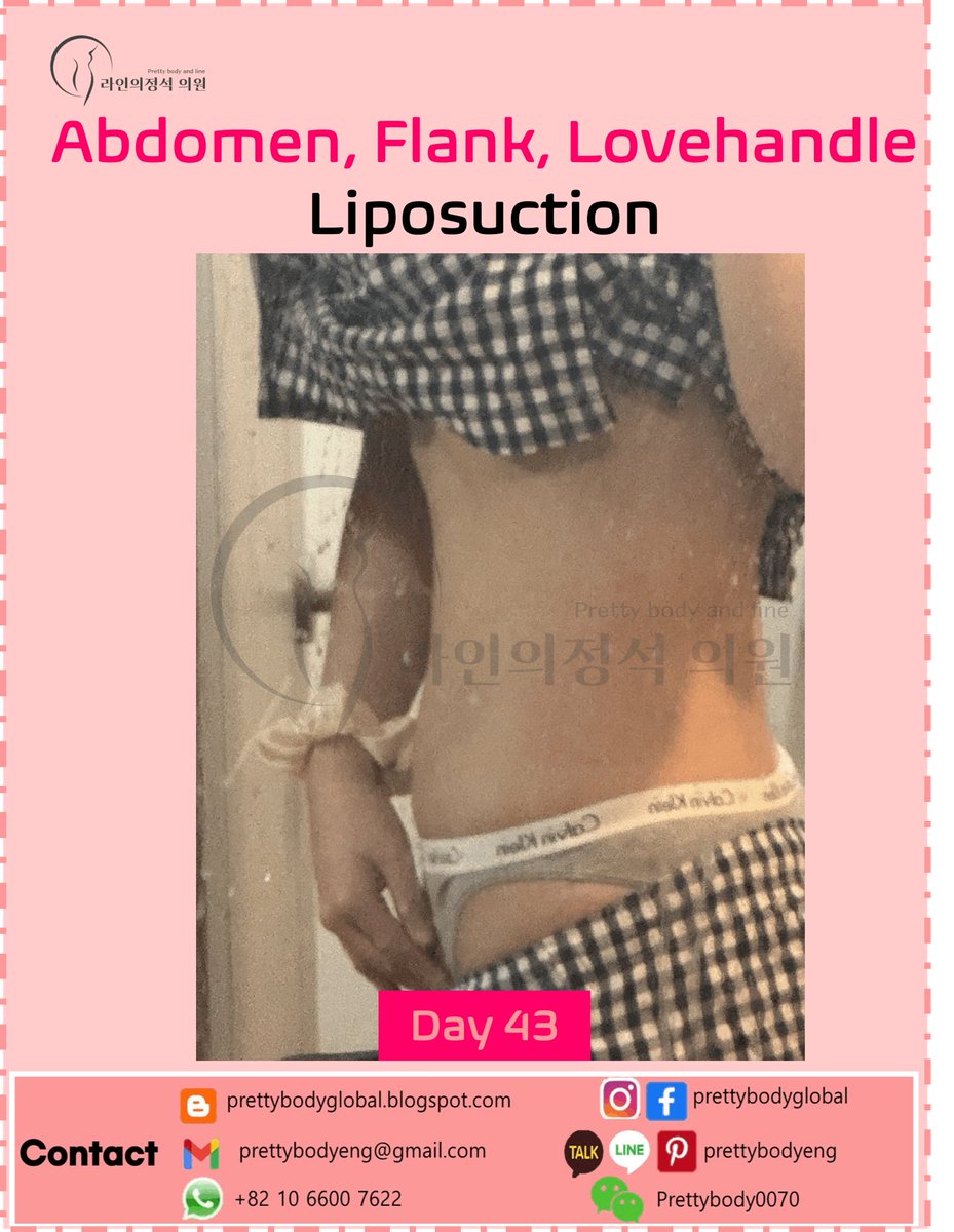 ClinicEng's tweet photo. #abdomenliposuction #narrowwaistlineliposuction #beautifultransformation #bodytransformation #liposuctioninkorea #bellybutton #hourglass #bodycontouring #reshapebody #barbieline #flatabdomen #lipo #liposuction #thighliposuction #calfliposuction #diet #bodybuild #Armliposuction https://t.co/p9BoieTuja