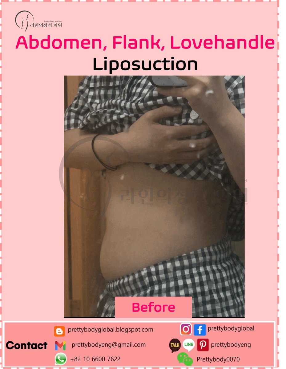 ClinicEng's tweet photo. #abdomenliposuction #narrowwaistlineliposuction #beautifultransformation #bodytransformation #liposuctioninkorea #bellybutton #hourglass #bodycontouring #reshapebody #barbieline #flatabdomen #lipo #liposuction #thighliposuction #calfliposuction #diet #bodybuild #Armliposuction https://t.co/p9BoieTuja