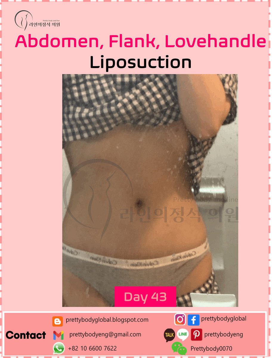 ClinicEng's tweet photo. #abdomenliposuction #narrowwaistlineliposuction #beautifultransformation #bodytransformation #liposuctioninkorea #bellybutton #hourglass #bodycontouring #reshapebody #barbieline #flatabdomen #lipo #liposuction #thighliposuction #calfliposuction #diet #bodybuild #Armliposuction https://t.co/p9BoieTuja