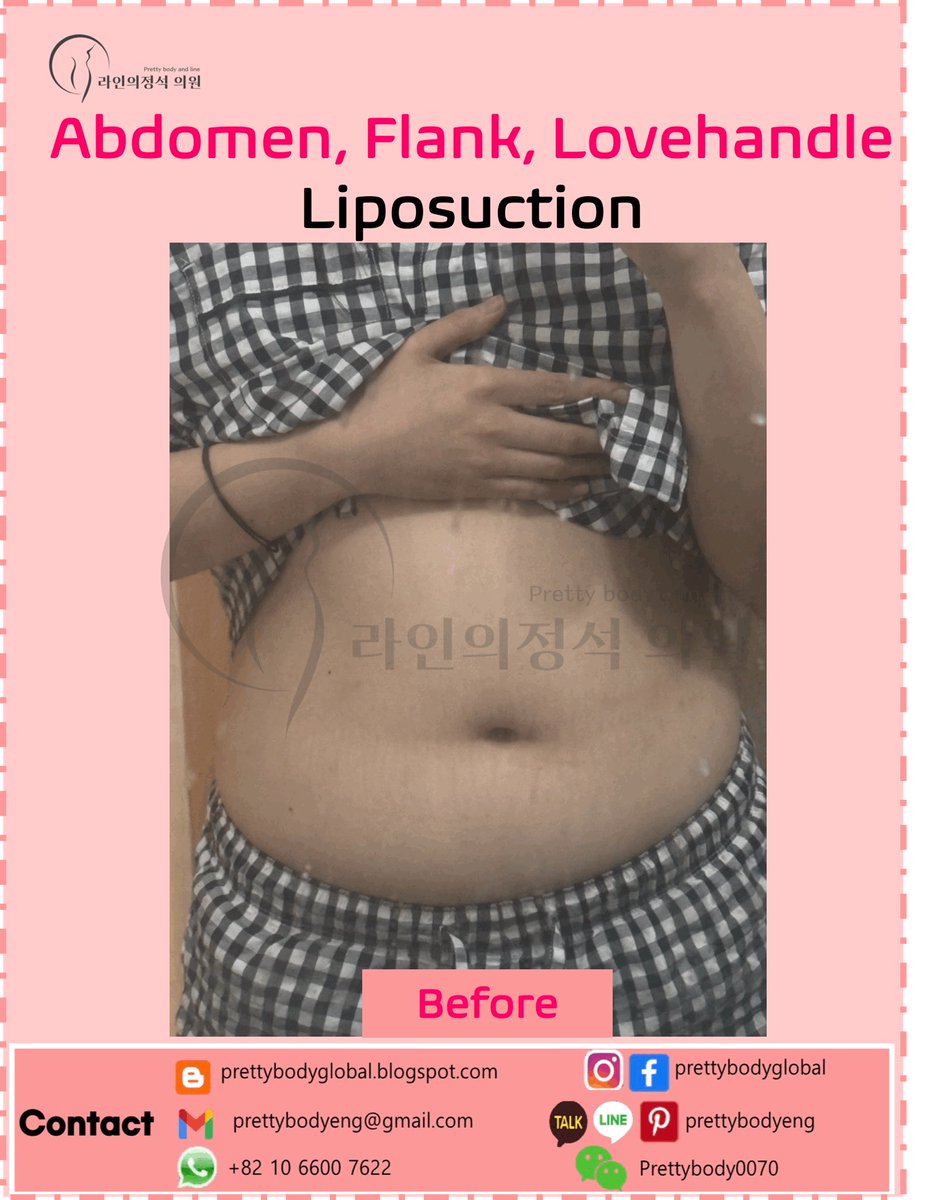 ClinicEng's tweet photo. #abdomenliposuction #narrowwaistlineliposuction #beautifultransformation #bodytransformation #liposuctioninkorea #bellybutton #hourglass #bodycontouring #reshapebody #barbieline #flatabdomen #lipo #liposuction #thighliposuction #calfliposuction #diet #bodybuild #Armliposuction https://t.co/p9BoieTuja