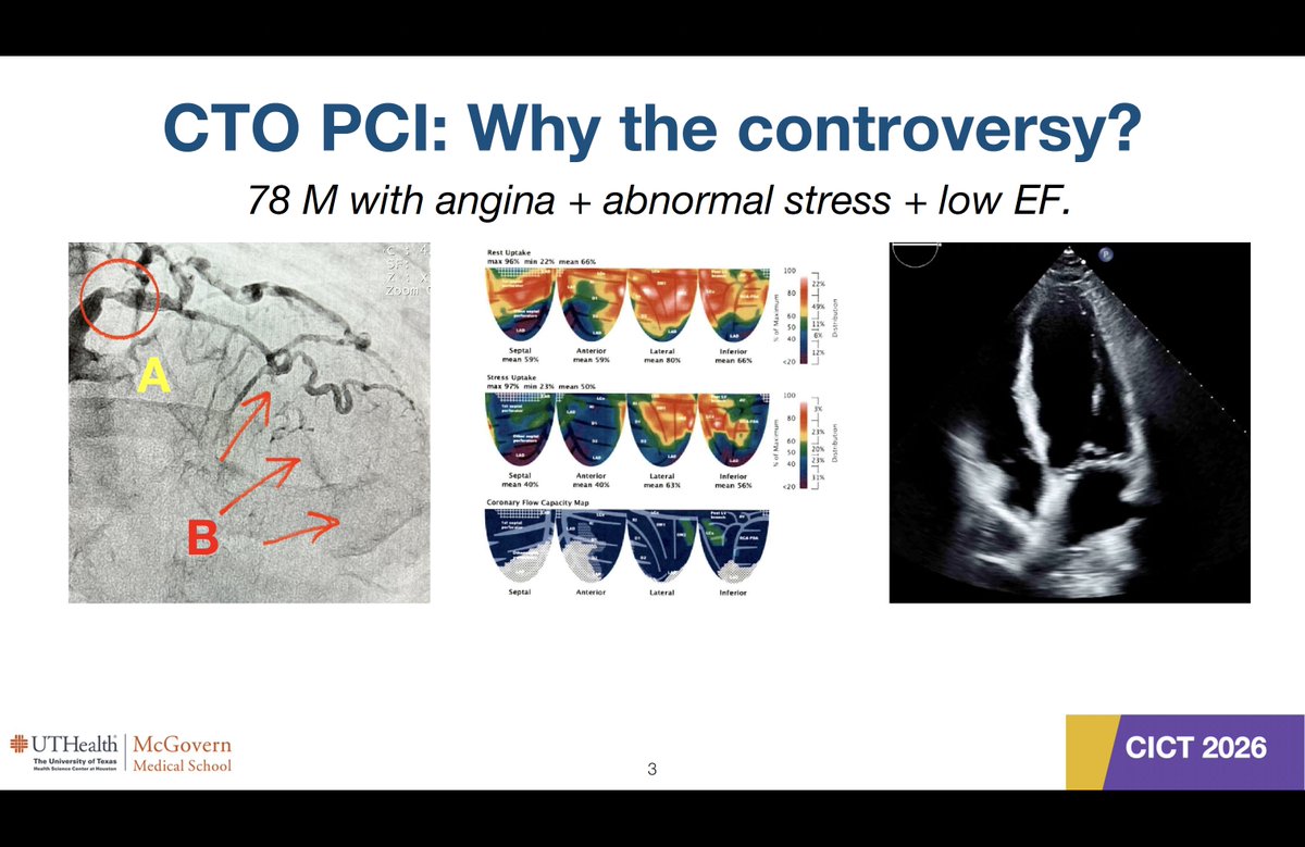 realarainmd's tweet photo. Proposition - OPTIMA-CTO Leaves No Doubt: CTO PCI Improves Symptoms

This was the title of my talk at #CICT2026 last week. I was debating good friend and fellow CTO enthusiast, @jbspadoni.

I only had 8 minutes - so a sophisticated analysis a la @SripalBangalore, @djc795, or @ihtanboga was out! 😅

Here are the slides...