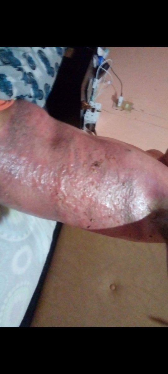 IsraChuy23's tweet photo. @Vikingonegroa Como olvidar cuando me electrocute mi vikingo trabajando poniendo internet tenía 19 años y ponía antenas que funcionaban con red microondas poniendo una sobre en una fachada de una casa y arriba pasaban cables de alta tensión y me aventó desde un piso.. https://t.co/bHhkhw1Dni