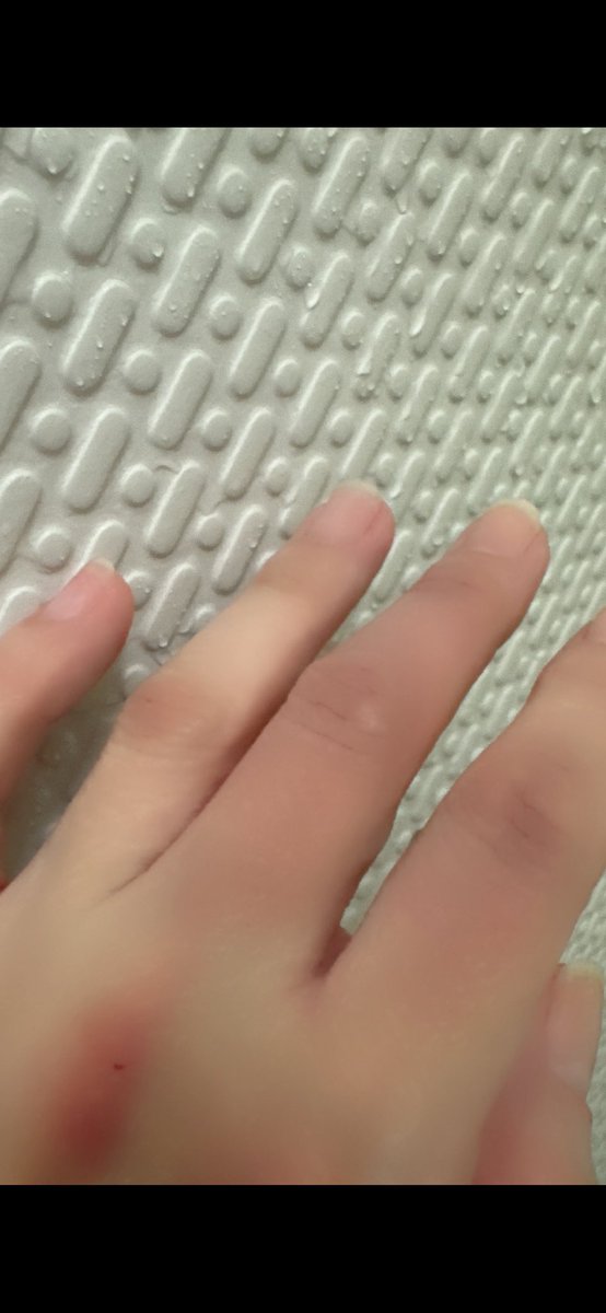 Fuga820's tweet photo. 一昨日
踏切内の線路
盛大にズッコケた😭

2倍近くの指の腫れやっとひいてきた
キーボード打てなくて
仕事にならなすぎて馬鹿
利き手じゃないのがギリ救い。
手術後、お薬継続で服用してるんだけど
左足の痺れで自覚のないくらい
足が上がってないみたい
それにしてもバカ痛いぃぃ😣

コレが理由。 https://t.co/gpyPT9PsbF