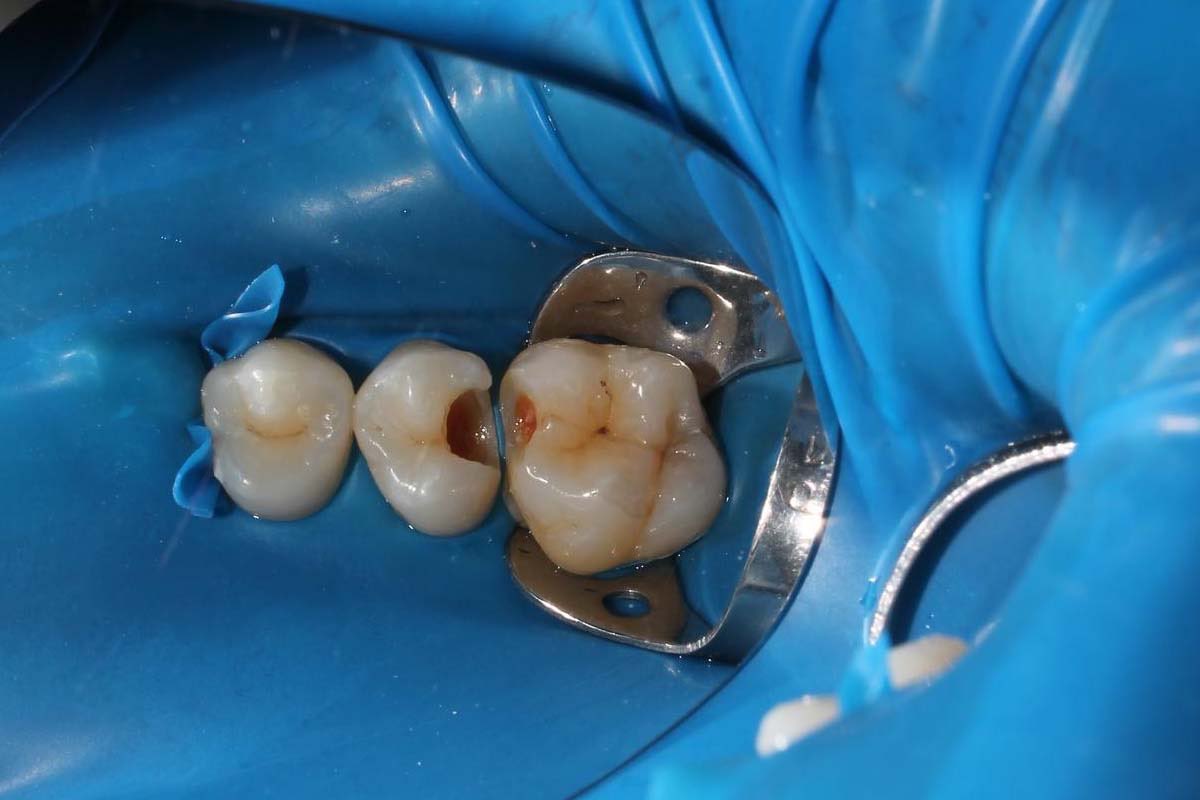 zaidamazda's tweet photo. Punya tambalan komposit/amalgam di gigi belakang yang mulai ngilu, terselip makanan, atau gompal? 🤔

Cocok buat yang:
- Punya tambalan lama (hitam/sewarna gigi) yang retak, bocor, atau lepas
- Gigi geraham berlubang lumayan besar

#perawatangigigratis https://t.co/cinbTIhHrR