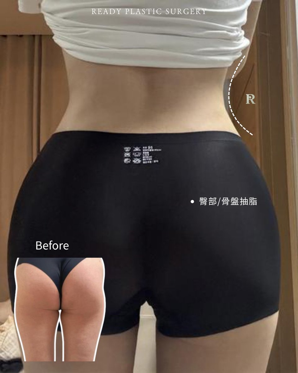 ReadyPs21885's tweet photo. 好的體雕，不只是瘦，而是比例。

大腿抽脂＋臀部／骨盆自體脂肪移植，讓多餘脂肪重新分配，改善腰臀曲線與整體身形比例。

自然的線條，往往比誇張的改變更耐看。

#Ready整形醫院 #手臂抽脂 #超能電漿 #自體脂肪隆乳 #抽脂 #韓國醫美 #醫美優惠 #韓國整形#韓國生活#臀控 https://t.co/6hjsXE1mLT