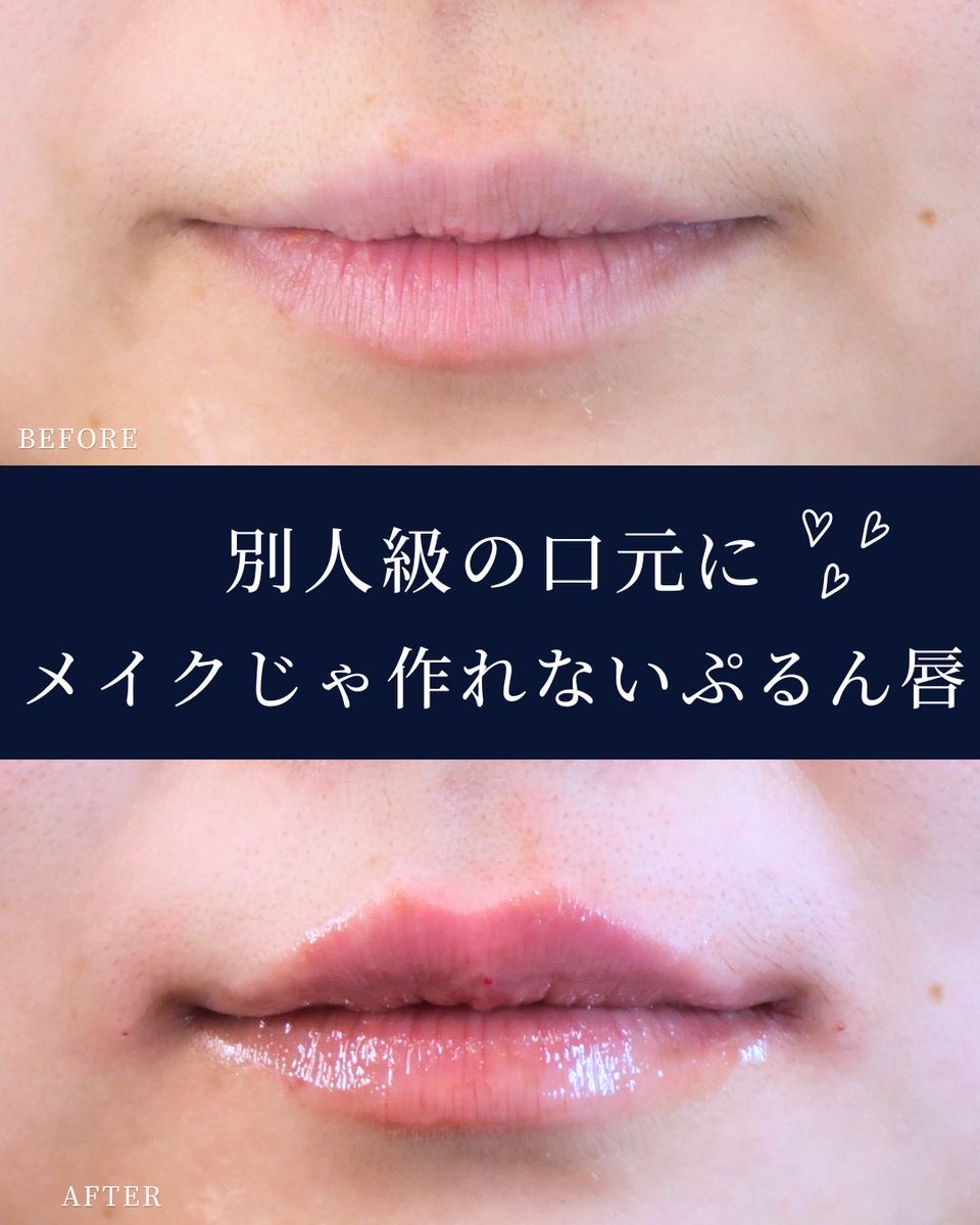 GardenClinicNet's tweet photo. 20代女性
唇ヒアルロン酸注入💋✨

施術料金：55,000円（税込）〜132,000円（税込）
※使用製剤・注入量により異なります

注意事項：腫れ、内出血、赤み、痛みなどが生じる場合がありますが、通常は数日〜2週間程度で改善します。

↓ヒアルロン酸の詳細はこちらをチェック
https://t.co/FzhimtW4jw https://t.co/anq4vxkUUt