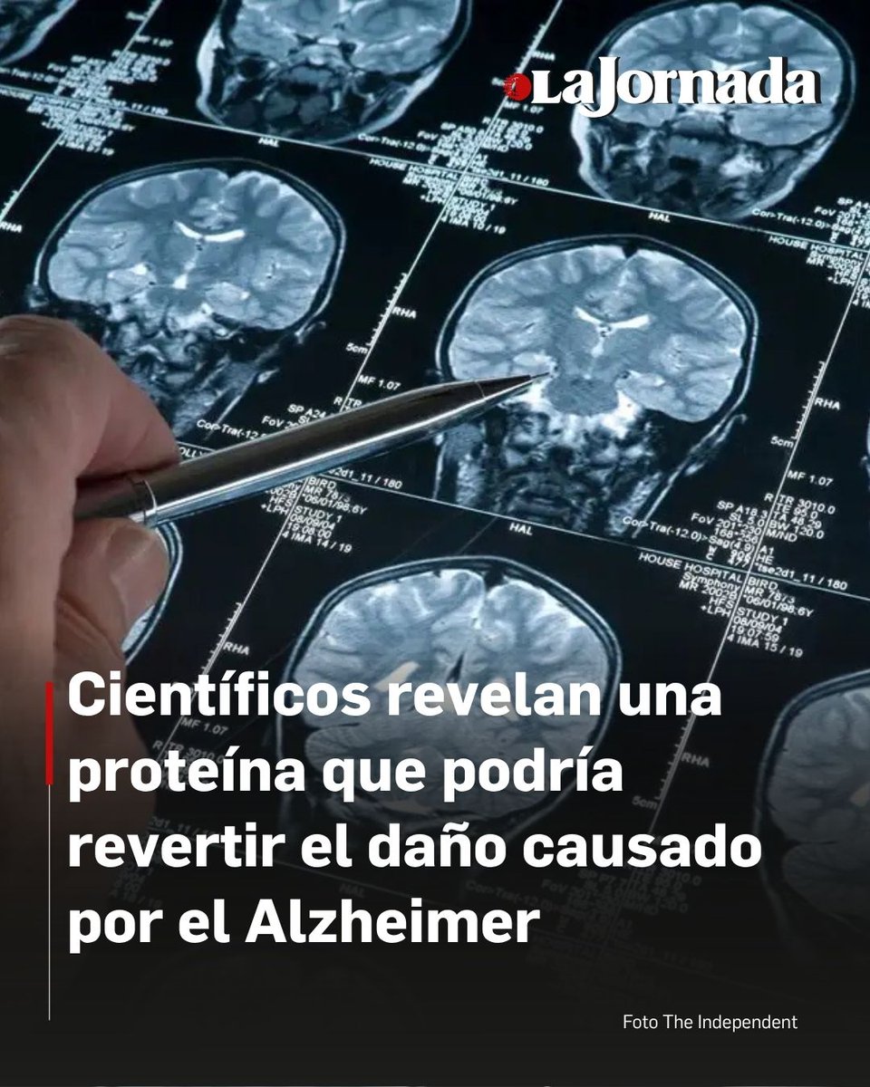lajornadaonline's tweet photo. 🧠 Un estudio científico identificó una proteína natural del cerebro que podría ayudar a proteger contra el daño provocado por el Alzheimer.

🔬 Investigadores del Sanford Burnham Prebys descubrieron que aumentar los niveles de SORLA reduce la acumulación de ovillos tóxicos de la proteína tau, relacionados con la pérdida de conexiones neuronales y el deterioro cognitivo.

🧪 Aunque los resultados son prometedores en modelos animales, los científicos señalan que aún se requiere más investigación para desarrollar tratamientos aplicables en humanos.

https://t.co/fJ6aUsTQhr
