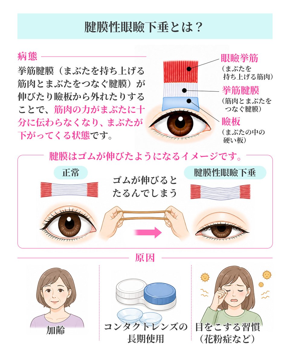 biyohihuka_kobe's tweet photo. 「まぶたが重い」「視界が狭く感じる」
それ、眼瞼下垂かもしれません。
眼瞼下垂は、見えにくさだけでなく、額のしわや肩こり、眠たそうな印象につながることもあります。

当院では、症状に応じて保険診療・自由診療から適した治療をご提案しています。

気になる方はお気軽にご相談ください😊 https://t.co/xksnmduVdl