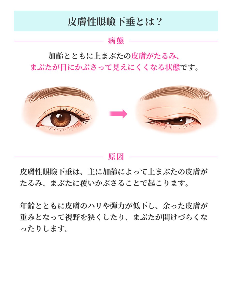 biyohihuka_kobe's tweet photo. 「まぶたが重い」「視界が狭く感じる」
それ、眼瞼下垂かもしれません。
眼瞼下垂は、見えにくさだけでなく、額のしわや肩こり、眠たそうな印象につながることもあります。

当院では、症状に応じて保険診療・自由診療から適した治療をご提案しています。

気になる方はお気軽にご相談ください😊 https://t.co/xksnmduVdl