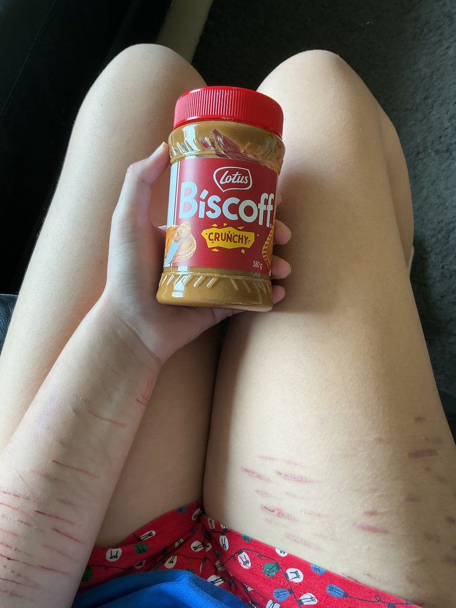 rasptwip's tweet photo. Just some scars from a long while ago #shedtwt #shtwt https://t.co/42vCeTOP40