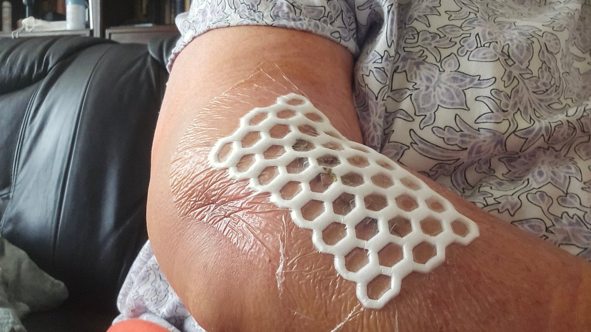 Pinscherin's tweet photo. Arm kaputt: Radiusköpfchenfraktur Mason Typ 3. 💥 Jetzt mit schicker Prothese &amp; geflickten Bändern. Gestern sind die Klammern rausgeflogen! 🥳  6 Wochen 0 kg Belastung, Orthese sitzt, Physio läuft. 🦾 #EllenbogenOP #Radiusköpfchenfraktur #Recovery https://t.co/FpAsLbcMoT