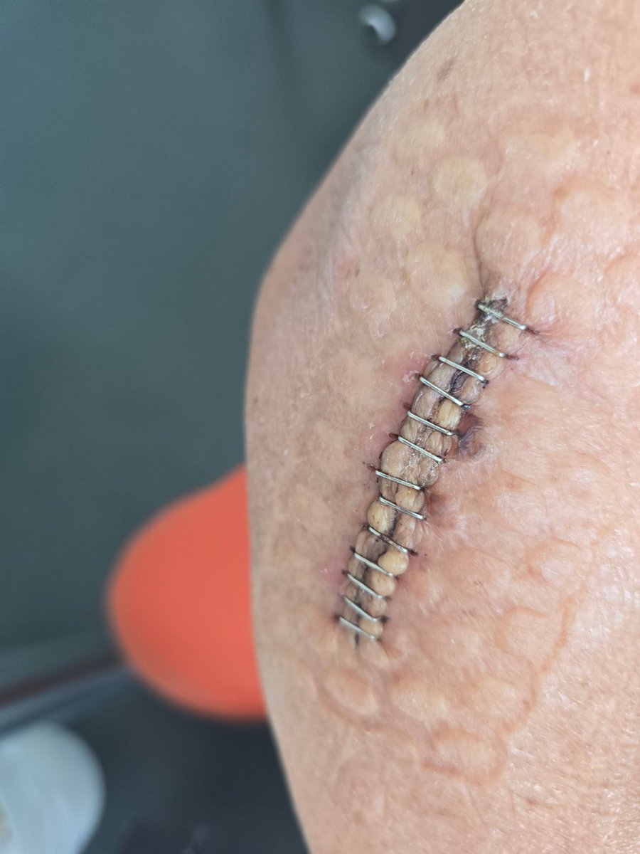 Pinscherin's tweet photo. Arm kaputt: Radiusköpfchenfraktur Mason Typ 3. 💥 Jetzt mit schicker Prothese &amp; geflickten Bändern. Gestern sind die Klammern rausgeflogen! 🥳  6 Wochen 0 kg Belastung, Orthese sitzt, Physio läuft. 🦾 #EllenbogenOP #Radiusköpfchenfraktur #Recovery https://t.co/FpAsLbcMoT