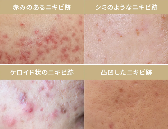 ShannonBabehhh's tweet photo. 「ねぇ、ニキビ跡ってもう一生このままなの…？」

昨日、成田から着いたばかりの妹に泣きながら聞かれた。

答え：
 ✅赤いニキビ跡 → ジェネシスレーザー
 ✅凸凹クレーター → ポテンツァ・CO2レーザー
 ✅開いた毛穴 → ポテンツァ＋リジュラン
 ✅今できてるニキビ → アグネス（膿を吸引）
 ✅色素沈着 → ケミカルピーリング

江南で12年、ニキビ跡だけ診てきた専門医が
30分カウンセリングで肌タイプ別に設計してくれる。

「日本で40万のやつがここでは11万」