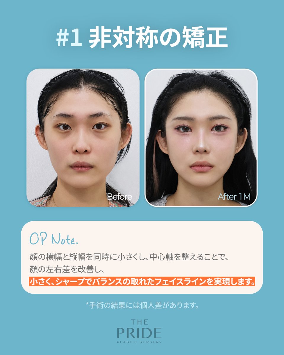 thepride_jp's tweet photo. 輪郭骨切り症例 ZIP.

ザ・プライドでは、小顔効果だけでなく、
左右差の改善やなめらかなフェイスライン形成など、
さまざまな症例に対応しています。

輪郭整形専門医 イ・ドンフン院長が執刀いたします。

📩お問い合わせ：https://t.co/SBDEo8DXGn

#輪郭手術 #骨切り #輪郭3点 https://t.co/9FWSFBScQv