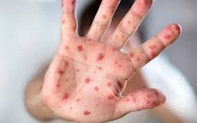 PalPress24's tweet photo. Dr. Mohammed Abu Salmiya, Director of Al-Shifa Medical Complex:

▪️ Around 5,000 new cases of chickenpox and skin diseases are being recorded every week due to the spread of epidemics and the lack of vaccines and medicines in displacement centers.

▪️ Four to five cancer patients die every day after being deprived of chemotherapy. Meanwhile, the conditions of kidney failure patients and children with diabetes continue to deteriorate because of severe shortages of medications and insulin.