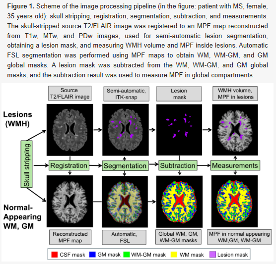 HarrySpoelstra's tweet photo. MRI-Based Quantitative Assessment of Normal-Appearing White and Gray Matter Demyelination in Multiple Sclerosis, Parkinson’s Disease, Long COVID, and Normal Aging

🚨LongC0VID scars the brain like MS & Parkinson’s: advanced MRI reveals hidden myelin damage in “normal-looking” Gray matter! #BRAINDAMAGE

➡️This very interesting Russian study used macromolecular proton fraction (MPF) mapping, an advanced quantitative MRI technique sensitive to myelin content, to assess global alterations in normal-appearing Gray matter (GM) and White matter (WM) outside focal lesions.

➡️They compared four groups totalling 196 participants:
- Multiple sclerosis (MS, n=42),
- Parkinson’s disease (PD, n=16),
- LongC0VID (LC, n=75), and
- Healthy volunteers (n=63) representing normal aging,
- Focused on tissue that appears normal on conventional MRI yet is known to show subtle damage in neurological disease and aging.

➡️Findings:
- MPF mapping detected clear age- and disease-related differences in brain myelination, especially pronounced in Gray matter, and proved sensitive enough for reliable detection.
- Significant MPF decreases (with WMH volume increases) occurred in global WM, WM-GM, and GM in normal aging (75–85 yrs) and in MS, PD, and LongC0VID patients, except no WM/WMH volume change in LongC0VID.
- MS showed the largest MPF drop.
- Among LongC0VID patients, those with depression or insomnia had the greatest global MPF reduction.
- Peak myelination in healthy controls occurred at ~42–46 years. MPF strongly correlated with disability (EDSS) in MS (strongest in GM, r = –0.71) and with disease stage in PD.

➡️Conclusion:
- MPF mapping detected age-related and disease-related differences in brain myelination.
- Changes were particularly pronounced in Gray matter.
- LongC0VID patients showed significant MPF reductions in global white matter, white-Gray matter, and especially Gray matter (without increased WMH volume). The greatest myelin loss occurred in those with depression or insomnia as post-COVID complications, demonstrating that LongC0VID causes measurable, hidden demyelination-like brain injury independent of atrophy, age, or gender.
- The method proved sensitive enough for reliable detection of these differences.

‼️So, this is the first study to compare disease-dependent differences in global White- and Gray-matter myelination across MS, Parkinson’s, LongC0VID, and normal aging using quantitative MPF mapping. Controlling for age and gender isolated the specific disease effects on myelin loss from demographic factors. These MPF reductions were also independent of brain atrophy. Advanced MPF MRI thus reveals that LongC0VID, like established neurodegenerative diseases, produces measurable, widespread impairments in brain myelination, especially in Gray matter, proving that “normal appearing” post-COVID tissue is often not normal. It supplies objective neuroimaging evidence that moves LongC0VID beyond subjective symptoms, validates MPF mapping as a practical, sensitive biomarker for large-scale clinical monitoring, and underscores the need for advanced imaging to track neurological sequelae of SARSCoV2.
#AvoidSars2 #AvoidReinfections
https://t.co/ScIS1uhMYn