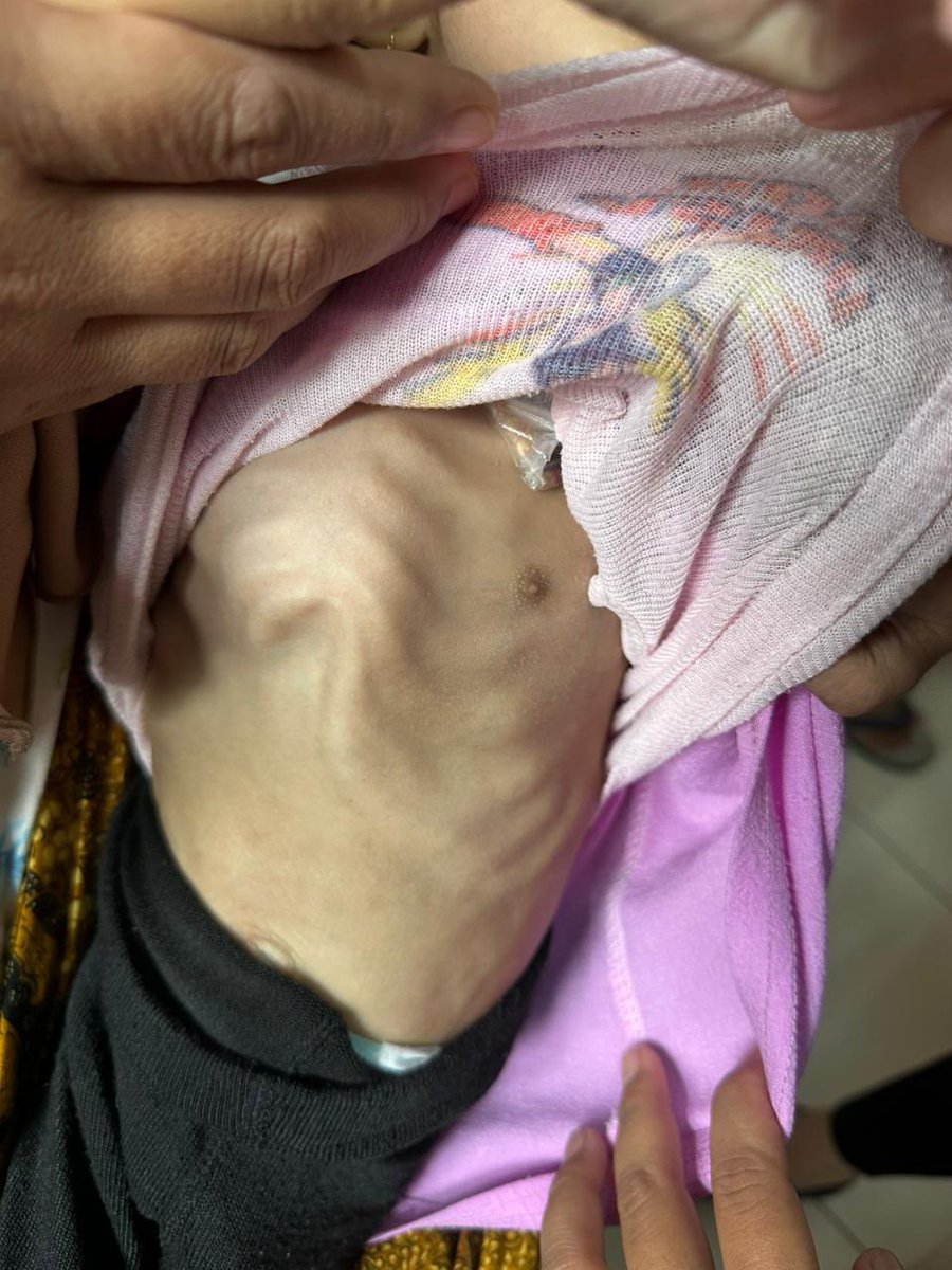 mytmrsn's tweet photo. Pernah denger istilah Marasmus/Kwashiorkor ga? 

Baik marasmus/kwashiorkor ini bentuk dari Gizi Buruk pada anak, tapi penampakannya beda banget.

Pict 1 keliatannya kurus banget (marasmus)
Pict 2 kurus yang ditandai dengan perut bengkak/buncit akibat dr kurang protein (kwashiorkor) 

Apa penyebabnya?
Marasmus : disebabkan karena tubuh kurang energi dalam jangka panjang
Kwashiorkor : disebabkan karena tubuh kurang protein