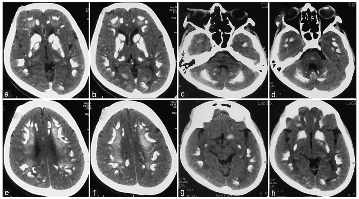AnnIndAcadNeur's tweet photo. Isolated hemichorea in adults can be a presenting feature of hypoparathyroidism with B/L basal ganglia calcification. Treatable with correction of underlying metabolic abnormality. Movement disorder + brain calcification -> r/o hypoparathyroidism
Link: 10.4103/aian.AIAN_123_18 https://t.co/VL7nYOlhwQ