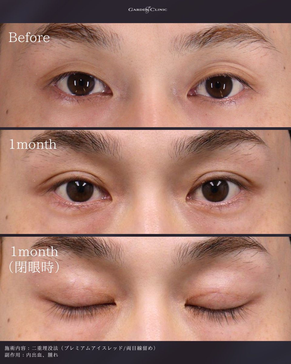 GardenClinicNet's tweet photo. 30代男性：術後1ヶ月🌿
施術内容：二重埋没法
注意事項：腫れ、内出血
●料金：59,400(税込)〜
↓二重整形の詳細はこちらをチェック
📷https://t.co/BmicL9g36H https://t.co/6w9YLAfH54