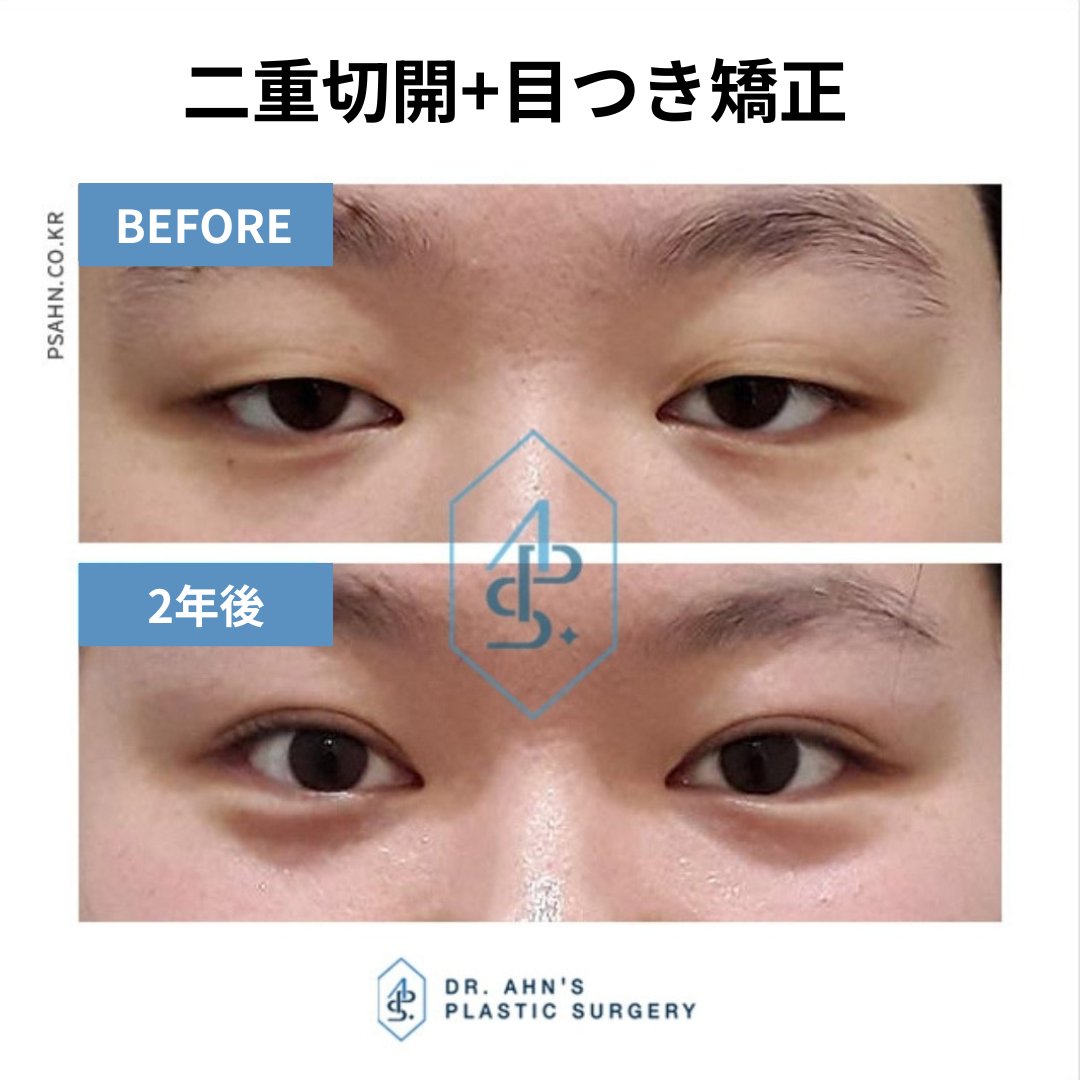dr_ahn_ps's tweet photo. 黒目の露出が80%以下だと眠く見える目だと感じます。
アジア人の場合、皮膚の被さりが多くて瞼が重い場合や眼瞼下垂の症状で黒目の露出が少ないことが多いです。

韓国で一番眼瞼下垂手術をしてると言っても過言ではない、Dr.アンにご相談ください✌️

LINEꔛhttps://t.co/Mg4CdsMM0V

#韓国整形 https://t.co/OBVMaWHdne