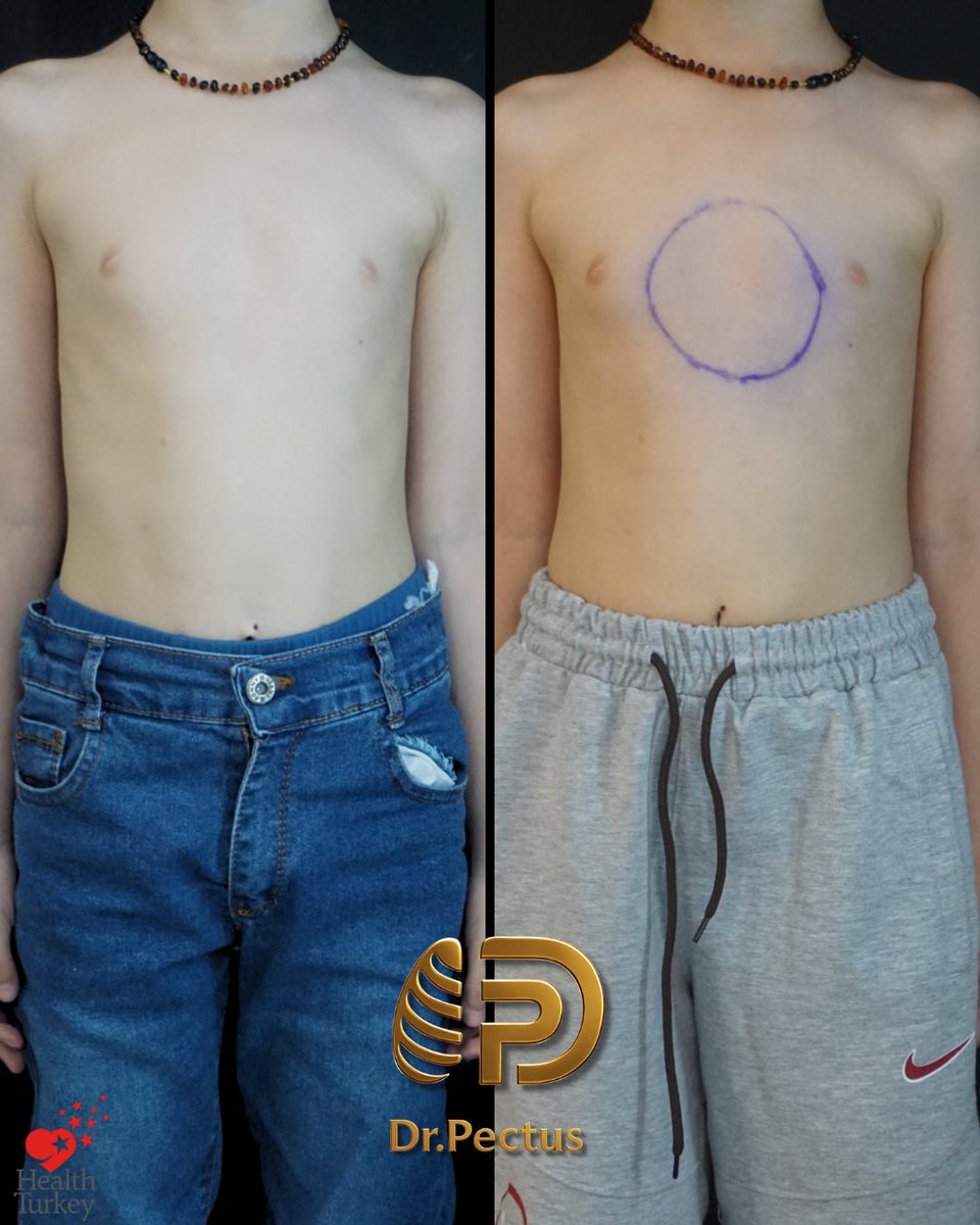 drpektus's tweet photo. 🩺✨ Not every pectus deformity requires surgery. With proper patient selection, individualized treatment planning, and good compliance, excellent outcomes can also be achieved with non-surgical treatment. 🤍

#pectus #pectusarcuatum #pectuscarinatum #vacuumbell #chestwall https://t.co/vWvwwhy3Cy