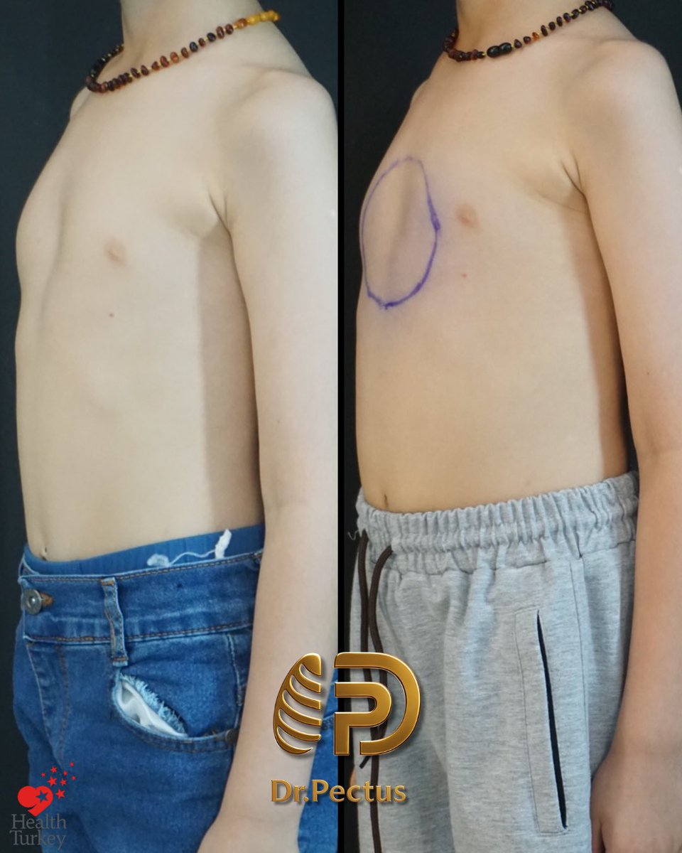 drpektus's tweet photo. 🩺✨ Not every pectus deformity requires surgery. With proper patient selection, individualized treatment planning, and good compliance, excellent outcomes can also be achieved with non-surgical treatment. 🤍

#pectus #pectusarcuatum #pectuscarinatum #vacuumbell #chestwall https://t.co/vWvwwhy3Cy