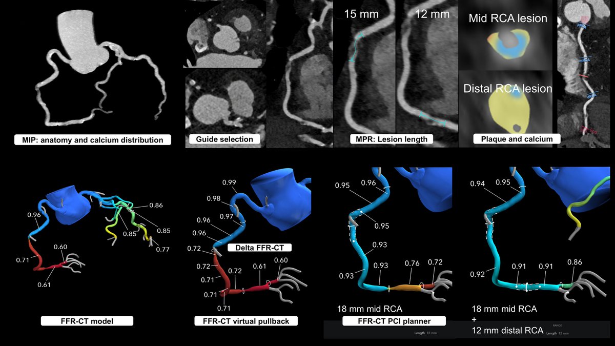 InvasiveCardiol's tweet photo. From the Coronary Imaging Topic Center 🔎 CCTA to Guide Percutaneous Coronary Intervention: Proceedings From the 1st CCTA-Guided PCI Summit in the US

Read here: https://t.co/9lm0oLAxed

@yadersandoval @DLBHATTMD #cardioTwitter #cardioX #cardiology #interventionalcardiology https://t.co/mN1fpF8lmd