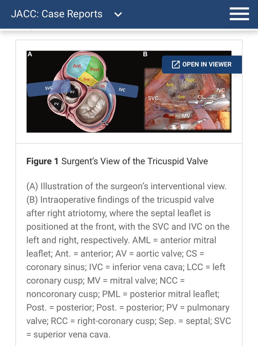 alex1708ander's tweet photo. Nice educational tool about the TEE(R) anatomy and spatial relationships of TV leaflets. Though I have to admit, I spent a minute wondering who the “surgent” was… until I realized it must be the upgraded version of the surgeon’s view 😂 #echofirst #TEER

https://t.co/nnrsZVvMWp https://t.co/gCBFMs7Jkd