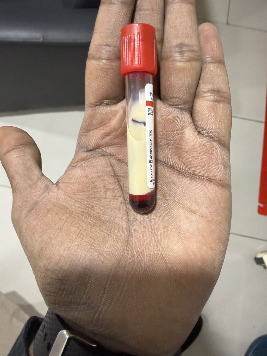 theajaydevb's tweet photo. This blood sample &amp; Pancreas ?? Guess the condition ? #Medtwitter https://t.co/WTZQi2wAsJ