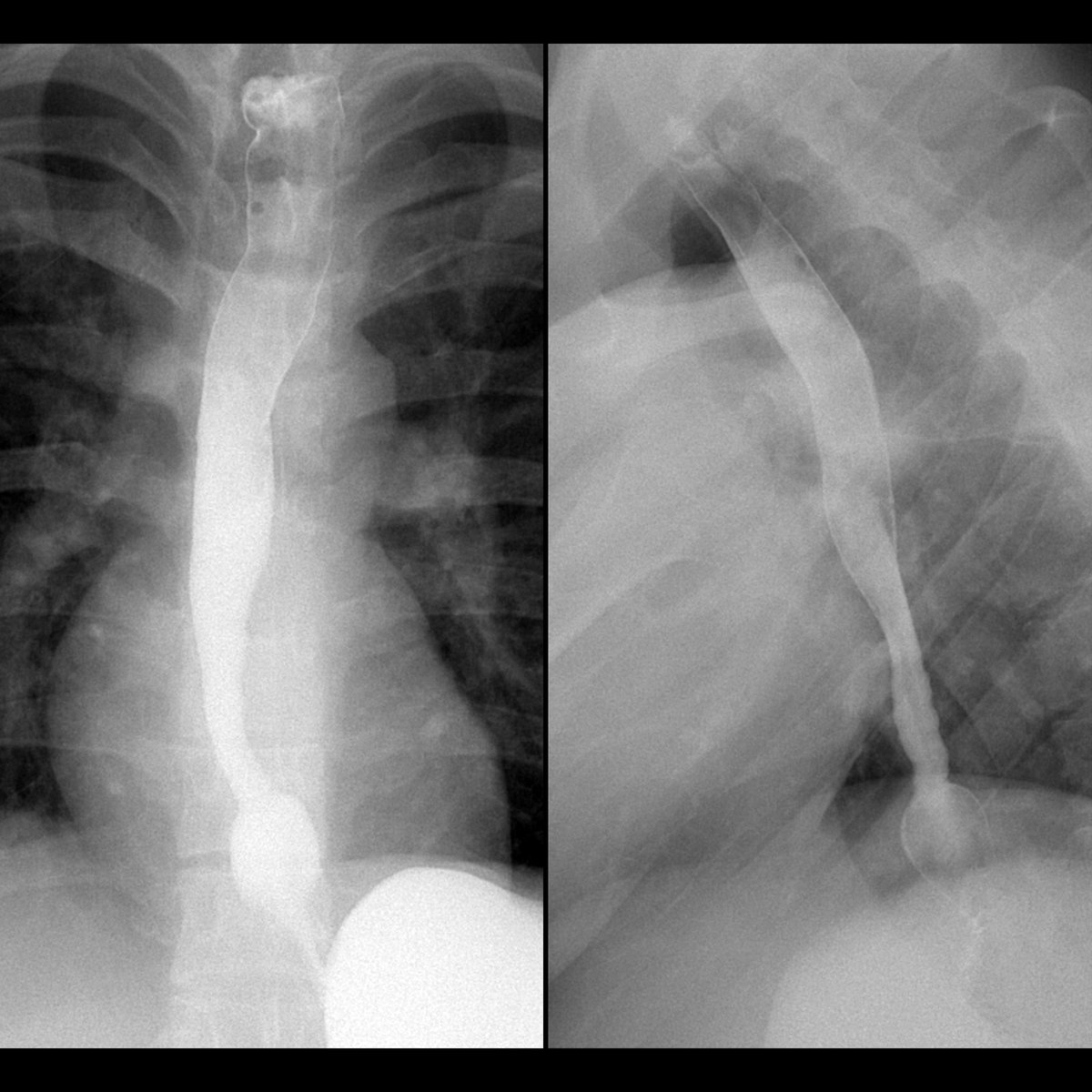 pedsimaging's tweet photo. Teen with dysphagia
AP image from upper GI exam (left) shows diffuse tapering of the distal mid-esophagus which resolves in the distal esophagus.
#FOAMed #MedEd #FOAMRad #PedsRad #RadEd #RadRes #radiology #pediatrics #radiologia #PedSurg #SoMe4PedSurg #radiologie #paediatrics https://t.co/NbAvwqeTla