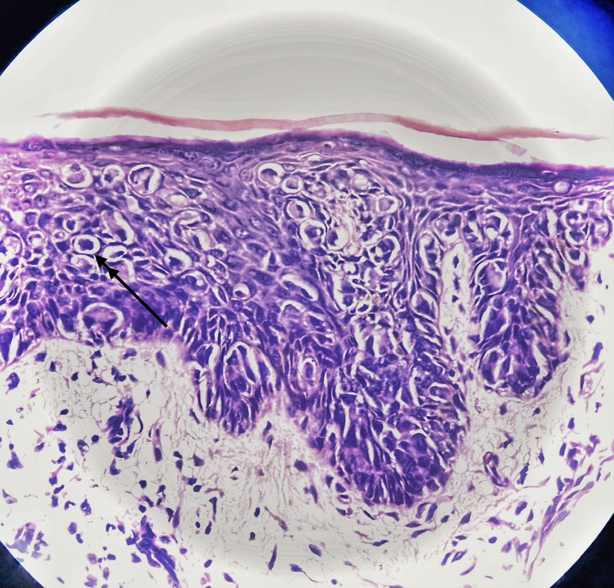 sripath25's tweet photo. Extramammary Paget’s Disease.  
💫 an intraepidermal adenocarcinoma, associated with Toker cells
💫single/clusters of Paget cells in epidermis with prominent nucleoli and occasional Mitoses(arrow). 
💫CK7, GCDFP-15,mucin stains,CEA,EMA ,GATA-3 positive
💫CK20,HER 2 negative. https://t.co/UFvyDqfD6w
