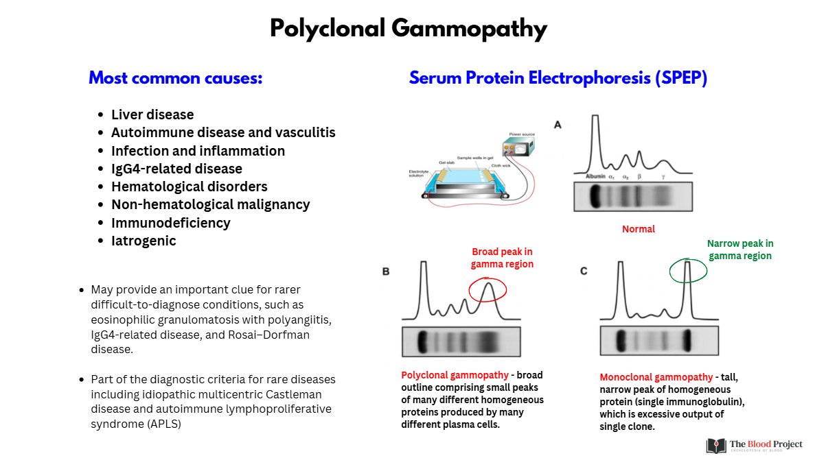 WilliamAird4's tweet photo. 1/2

POLYCLONAL GAMMOPATHY

A broad gamma-region peak on SPEP reflects increased production of many different immunoglobulins by many different plasma-cell clones.

Think inflammation, infection, autoimmune disease, liver disease, IgG4-related disease, and other reactive states. https://t.co/w45dgiESER