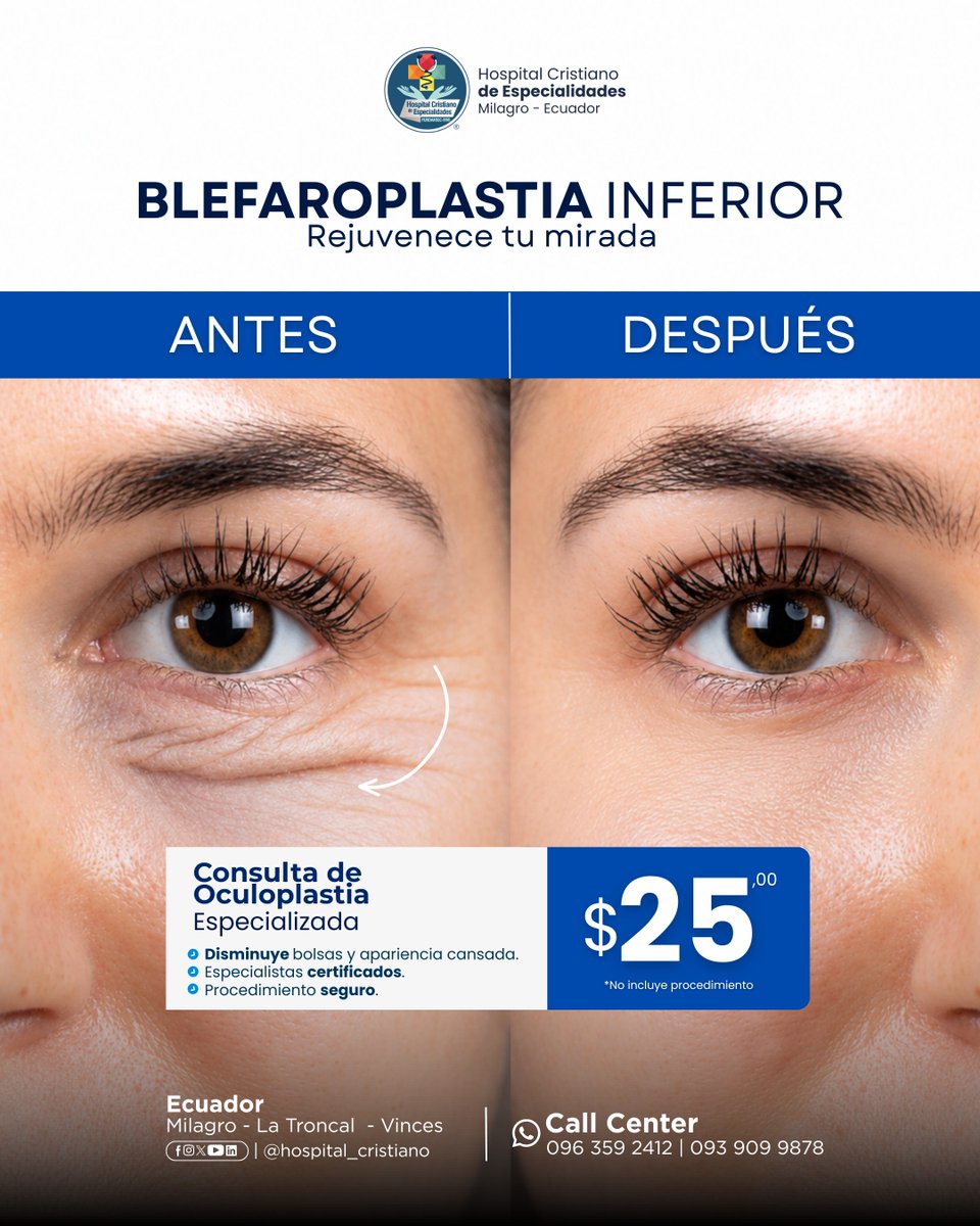 FundamiscHce's tweet photo. 👁️ Renueva tu mirada.

La blefaroplastia inferior ayuda a reducir las bolsas bajo los ojos y mejorar la armonía del rostro.

💰 Consulta con Oculoplastia: $25*
📲 096 359 2412
#Blefaroplastia #blefaroplasty #ojos #estética #salud https://t.co/4vCUJIwcoN