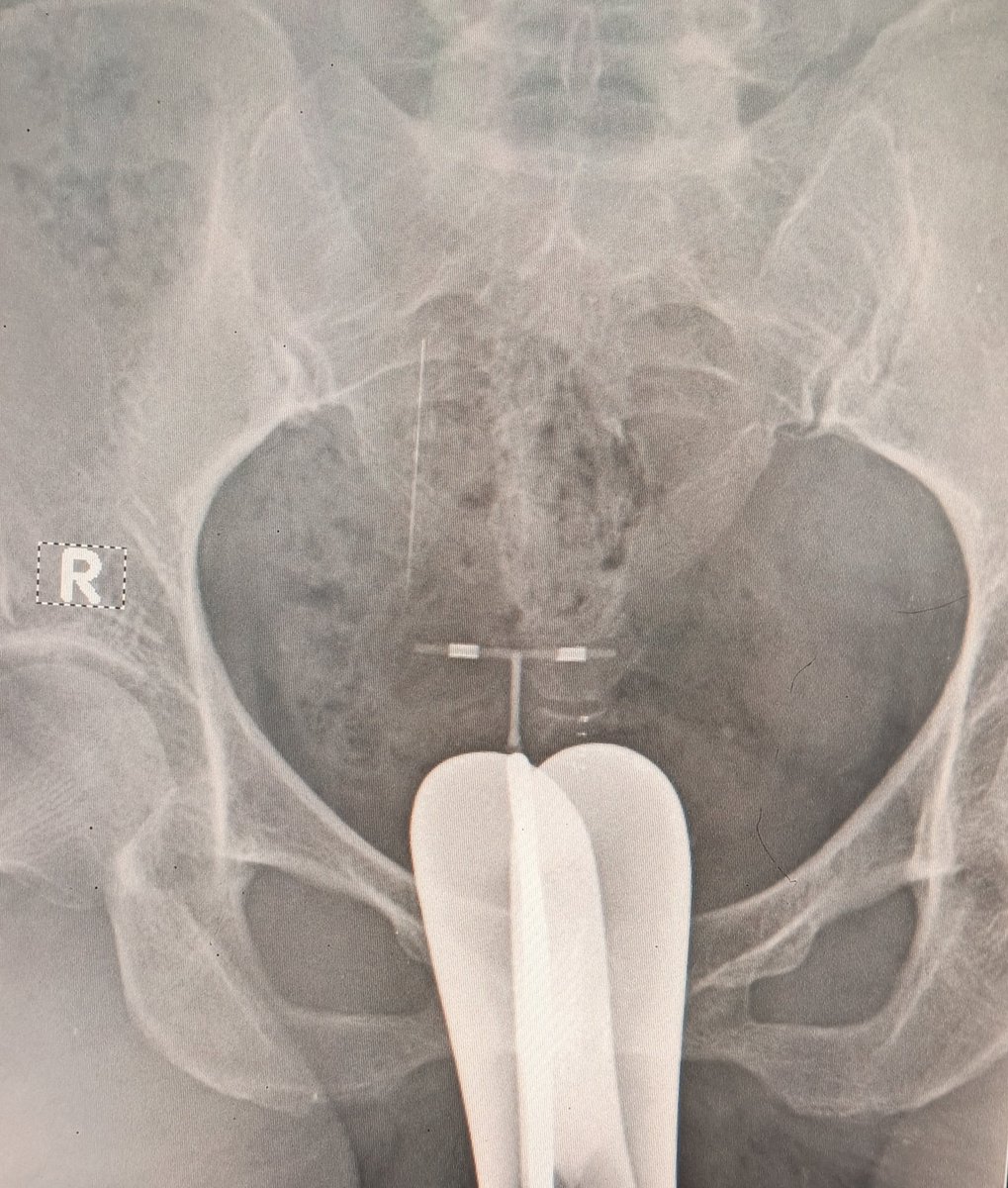 riki_hendr's tweet photo. Sebuah kasus menarik !!!

Pasien perempuan berusia 40 tahun sudah menikah dan memasang KB IUD, saat kontrol ke dokter obgyn ternyata IUD nya hilang, dokter obgyn pun meminta pemeriksaan BNO Sonde ke radiologi.

Kalian bisa lihat kan IUD nya pindah kemana? https://t.co/eTv6p2QEpu
