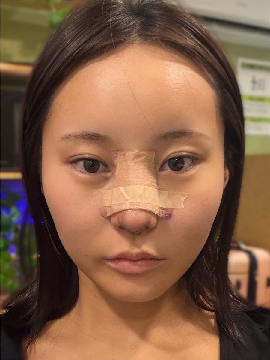 wj4616's tweet photo. 鼻フルDT5日目👃

腫れはさらに落ち着いてきて、横顔の変化が日毎に変わって、毎日楽しみ〜😆今日はアップノーズ感増してた気がする！
毎度言うけど、中顔面に立体感が出て本当に嬉しいなぁ🥹

まだ鼻先は硬い！痛みはほぼなし🙆‍♀️ 
明後日のギプス除去が楽しみ！ https://t.co/F8psrVNt4P