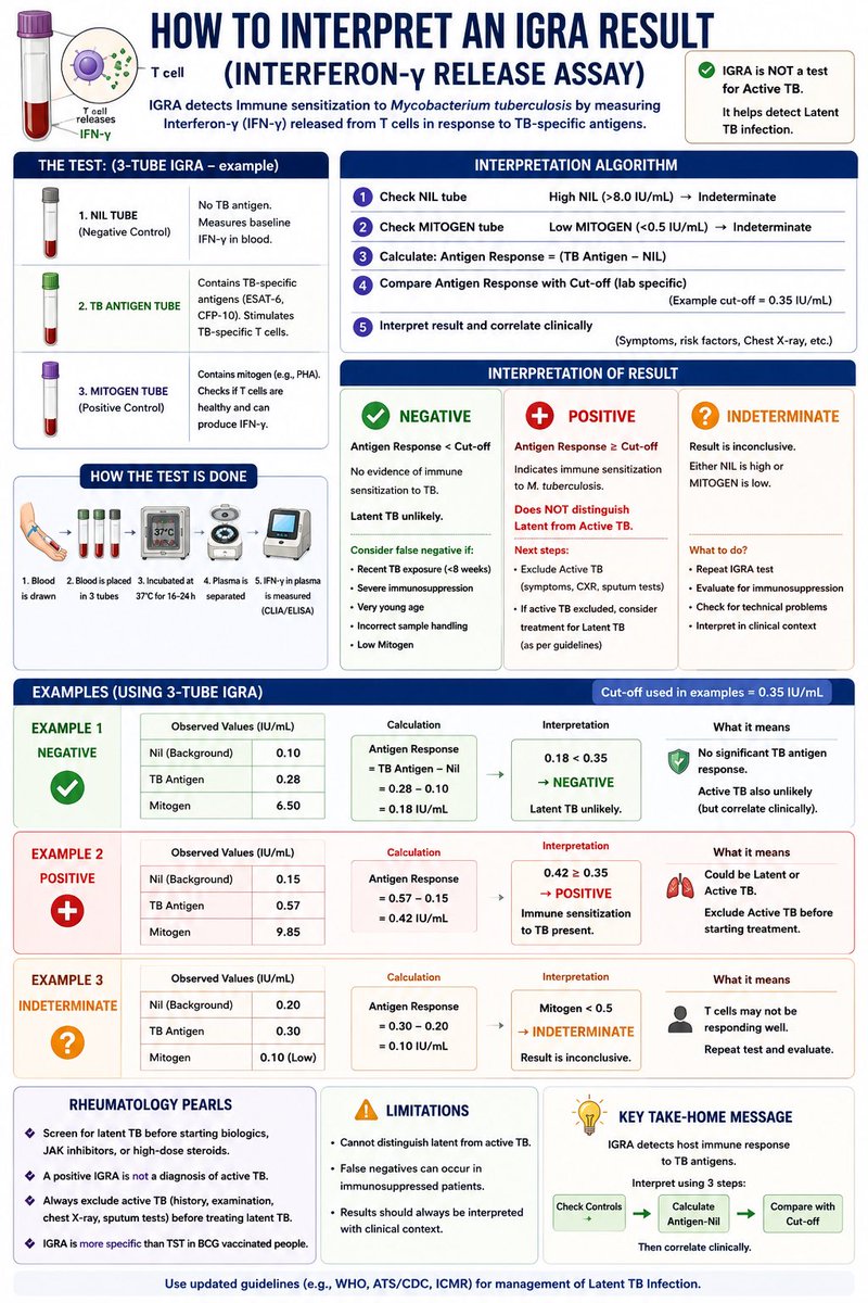 dr_immuno29's tweet photo. 🧪 IGRA Made Easy: From Sample Collection to Interpretation

1️⃣ What is IGRA?

Blood test to detect immune response against TB bacteria
Measures Interferon-gamma (IFN-γ) released by memory T cells
Detects TB infection (latent or active) but cannot distinguish between them

⸻

2️⃣ How is the test performed?

✅ Collect blood in special tubes

⚪ Nil tube → Background IFN-γ (Negative control)
🟢 TB Antigen tube (or TB1 & TB2) → Stimulates TB-specific T cells
🟣 Mitogen tube → Positive control; confirms healthy T-cell function

⬇️

Incubate at 37°C for 16–24 hours

⬇️

Separate plasma

⬇️

Measure IFN-γ using CLIA/ELISA

⬇️

Interpret results

⸻

3️⃣ How do you calculate the result?

TB Response = Antigen − Nil

Compare with laboratory cutoff.

⸻

4️⃣ Interpretation

🟢 Negative

Antigen − Nil below cutoff
No evidence of TB sensitization
Consider false negatives in immunosuppressed patients

🔴 Positive

Antigen − Nil above cutoff
Immune system has recognized Mycobacterium tuberculosis
Does NOT mean active TB
Evaluate clinically

🟡 Indeterminate

Low Mitogen or High Nil
Repeat test
Consider immunosuppression or technical issues

⸻

5️⃣ Role of each tube

⚪ Nil Tube

Measures baseline IFN-γ
Detects background inflammation

🟢 TB Antigen Tube

Contains ESAT-6 & CFP-10
Activates TB-specific memory T cells

🟣 Mitogen Tube

Strong non-specific T-cell stimulant
Confirms immune system is capable of producing IFN-γ

⸻

6️⃣ 3-Tube vs 4-Tube IGRA

3-Tube

Nil
TB Antigen
Mitogen
Mainly measures CD4⁺ T-cell response

4-Tube (QuantiFERON-TB Gold Plus)

Nil
TB1
TB2
Mitogen
Measures CD4⁺ + CD8⁺ T-cell responses
Preferred in many centres

⸻

7️⃣ Important limitations

❌ Cannot differentiate latent TB from active TB

❌ Cannot assess bacterial load

❌ Positive result may persist after previous TB infection or treatment

⸻

8️⃣ Practical example

Nil: 0.15 IU/mL

TB Antigen: 0.57 IU/mL

Mitogen: 9.85 IU/mL

TB Response = 0.57 − 0.15 = 0.42 IU/mL

➡️ Compare with laboratory cutoff

➡️ Report as Positive if above the validated cutoff.

⸻

9️⃣ Rheumatology Pearls

✔ Screen before:

TNF inhibitors
JAK inhibitors
IL-6 inhibitors
Rituximab
Abatacept

✔ Positive IGRA ≠ Active TB

✔ Always exclude active TB before treating latent TB or starting biologics.

🔑 Take-home Message

Remember the 3 Cs:

Controls → Nil & Mitogen
Calculation → Antigen − Nil
Clinical Correlation → Symptoms + Chest X-ray + Risk factors

IGRA detects immune memory, not live TB bacteria.