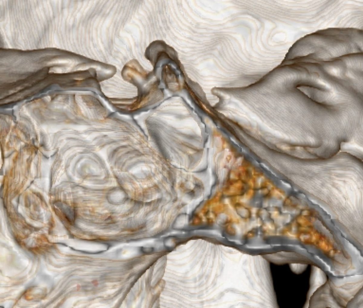 SharathKumarGG7's tweet photo. 🧠 Spotting a rare variant: The **Sellar Spine**!
This rare (<0.1%) congenital bony spur projects from the dorsum sellae into the sella turcica. Most cases are entirely incidental and asymptomatic, but recognizing it is crucial to avoid misdiagnosis.
💡 **Neuroradiology Pearl:** The SINGLE most important sign is its **cortical continuity with the dorsum sellae**. While it appears as a low-signal focus on an MRI, a thin-section bone-window CT (the best modality) will easily confirm its benign, bony nature!
Check out the infographic to learn how to confidently differentiate it from pathological conditions like pituitary microadenomas, meningiomas, and Rathke cleft cysts. 👇
#Radiology #Neuroradiology #MedEd #FOAMrad #MedicalImaging #Anatomy