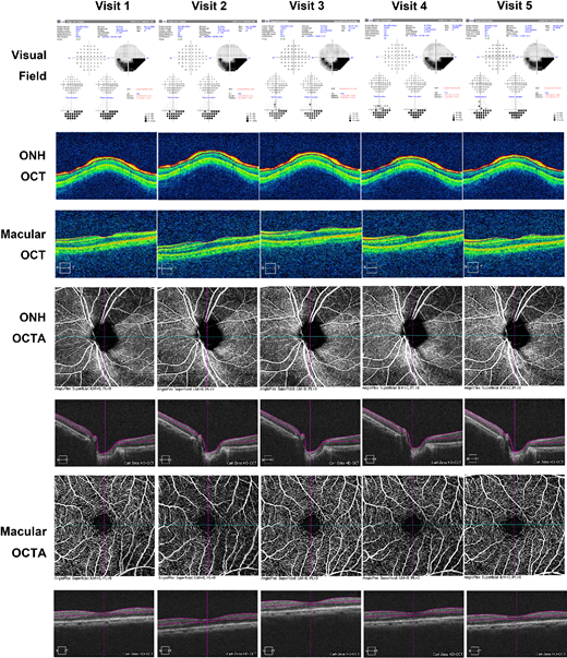 ARVOtvst's tweet photo. Jacqueline Chua et al. share their work on Reproducibility of VF, OCT, and OCTA in Glaucoma: A Prospective Multi-Visit Study, https://t.co/VMaFOwKeUh. https://t.co/xfex2mDv9n