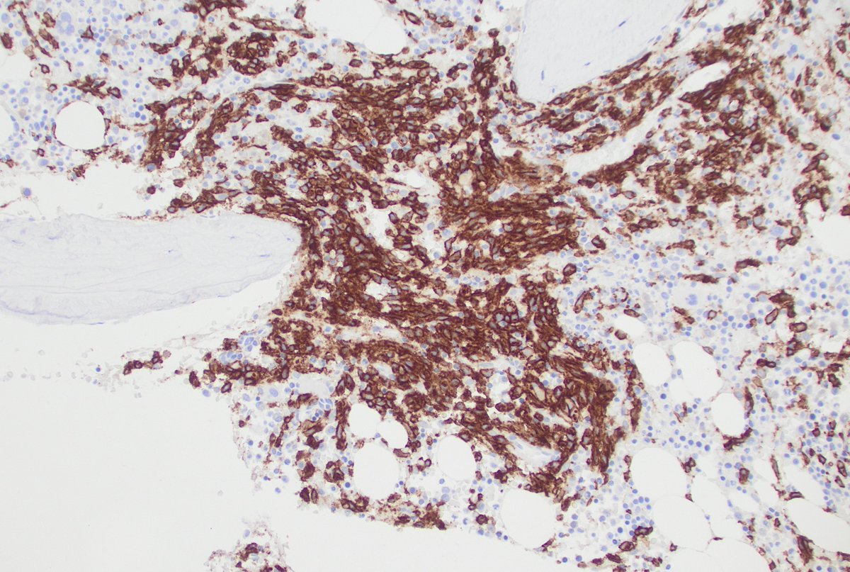 CUHemepath's tweet photo. @MirunaPopescu13 Yes it certainly is. Note the cytoplasmic pattern of expression of tryptase, compared to CD117 below (membranous) https://t.co/zG1Q23Qpr4