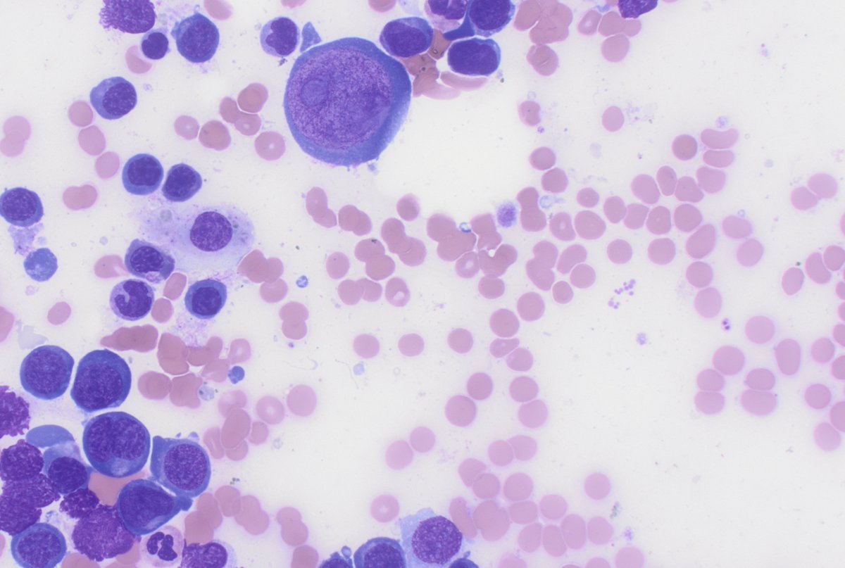CUHemepath's tweet photo. This person got a bone marrow biopsy for anemia. Any guesses as to the etiology?  #hemepath #pathboards https://t.co/iL6gErjti7