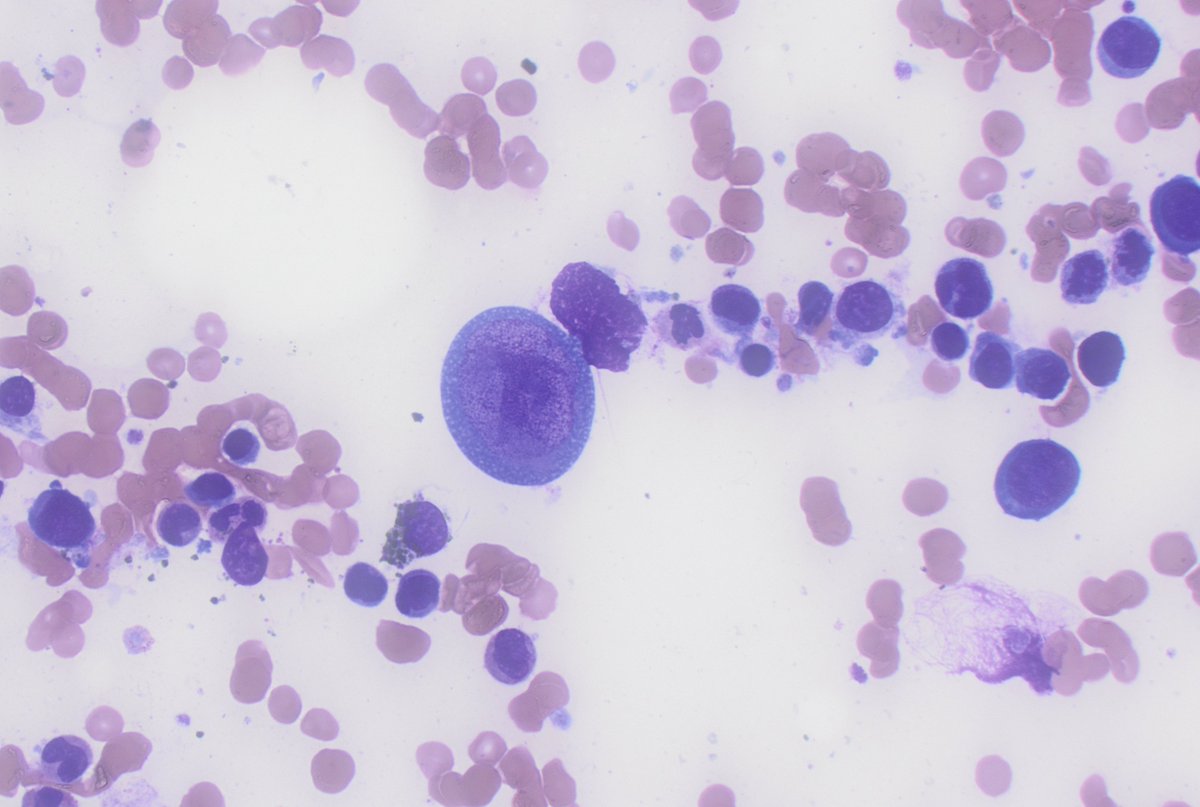 CUHemepath's tweet photo. This person got a bone marrow biopsy for anemia. Any guesses as to the etiology?  #hemepath #pathboards https://t.co/iL6gErjti7