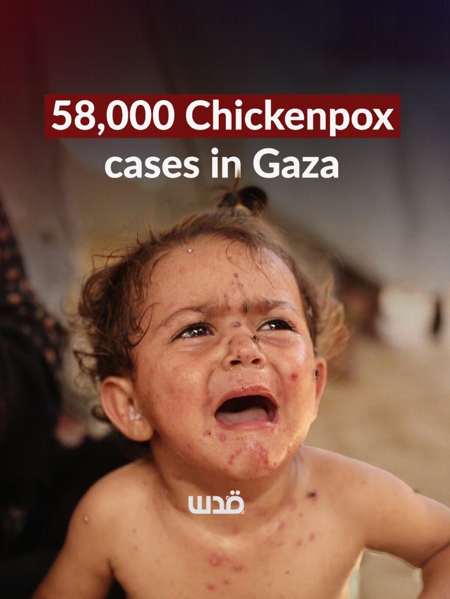 QudsNen's tweet photo. Gaza’s Ministry of Health has warned of a chickenpox outbreak after recording more than 58,000 cases since the start of 2026.

The ministry said worsening humanitarian and environmental conditions, including overcrowding and poor sanitation, are accelerating the spread of the disease.